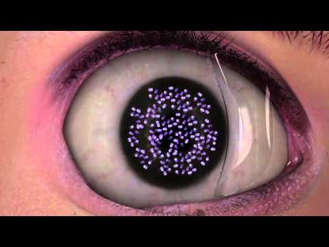 Corneal Cross Linking