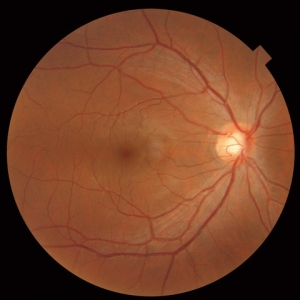 Retinal Detachment